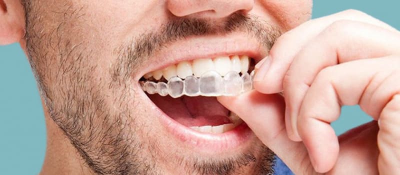 invisalign crystal aligner en tijuana