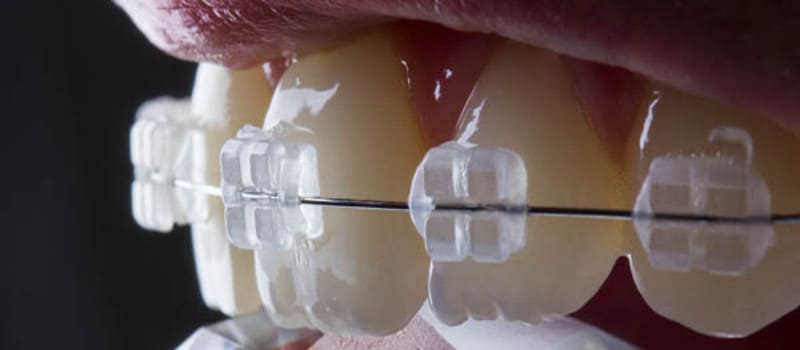 Ortodoncia estética convencional