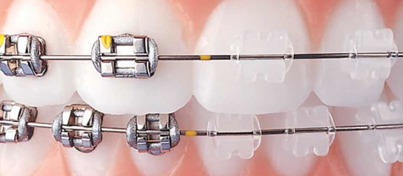metal braces vs clear ones