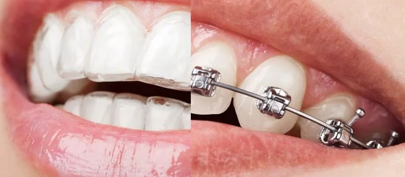 metal braces vs invisible