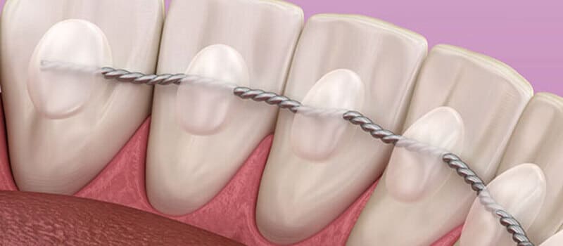 permanent bonded retainer